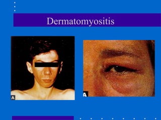 Dermatomyositis
 