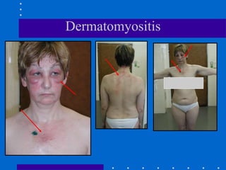 Dermatomyositis
 
