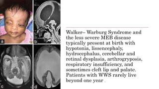 Walker– Warburg Syndrome and
the less severe MEB disease
typically present at birth with
hypotonia, lissencephaly,
hydrocephalus, cerebellar and
retinal dysplasia, arthrogryposis,
respiratory insufficiency, and
sometimes cleft lip and palate.
Patients with WWS rarely live
beyond one year .
 