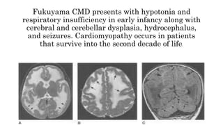 Fukuyama CMD presents with hypotonia and
respiratory insufficiency in early infancy along with
cerebral and cerebellar dysplasia, hydrocephalus,
and seizures. Cardiomyopathy occurs in patients
that survive into the second decade of life.
 