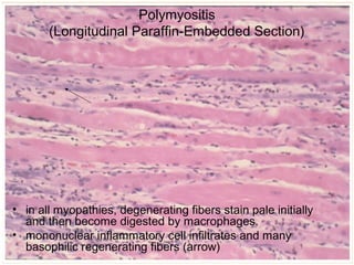 Polymyositis
(Longitudinal Paraffin-Embedded Section)
• in all myopathies, degenerating fibers stain pale initially
and then become digested by macrophages.
• mononuclear inflammatory cell infiltrates and many
basophilic regenerating fibers (arrow)
 