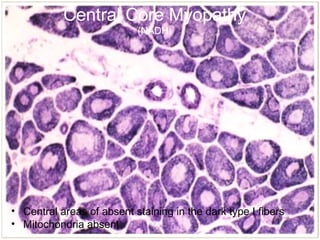 Central Core Myopathy
(NADH)
• Central areas of absent staining in the dark type I fibers
• Mitochondria absent
 