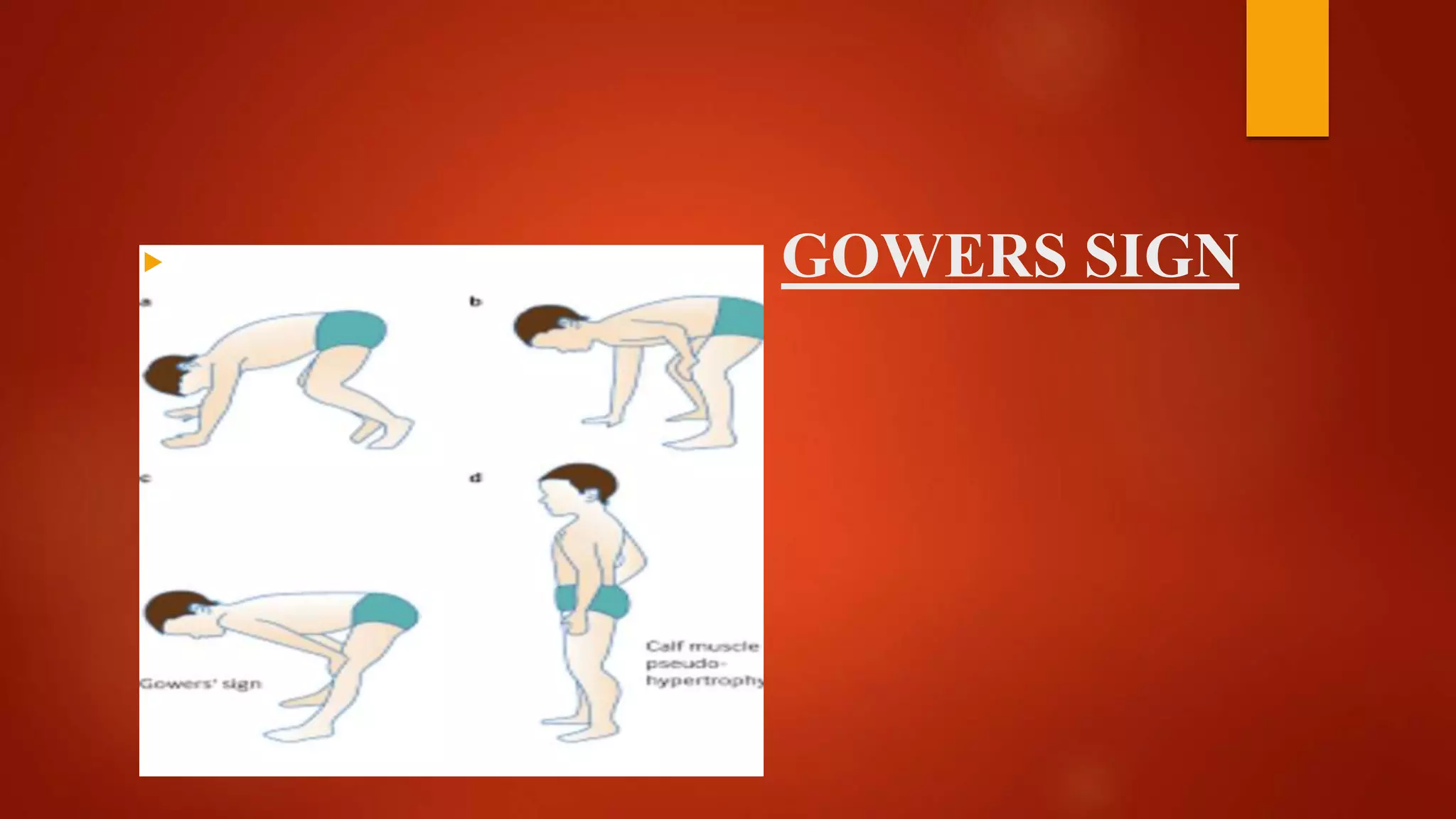 GOWERS SIGN
 S
 