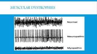 MUSCULAR DYSTROPHIES
 