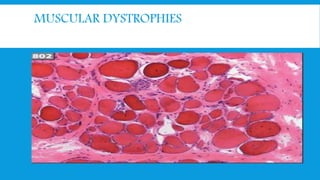 MUSCULAR DYSTROPHIES
 