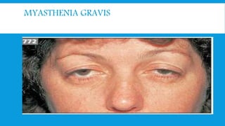 MYASTHENIA GRAVIS
 