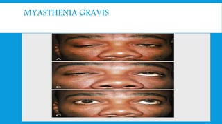 MYASTHENIA GRAVIS
Work-up
 