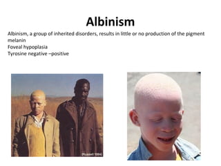 Albinism
Albinism, a group of inherited disorders, results in little or no production of the pigment
melanin
Foveal hypoplasia
Tyrosine negative –positive

 