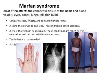 Marfan syndrome

most often affects the connective tissue of the heart and blood
vessels, eyes, bones, lungs, tall, thin build.
•

Long arms, legs, fingers, and toes and flexible joints.

•

A spine that curves to one side. This condition is called scoliosis .

•

A chest that sinks in or sticks out. These conditions are called pectus
excavatum and pectus carinatum respectively.

•

Teeth that are too crowded.

•

Flat feet.

 