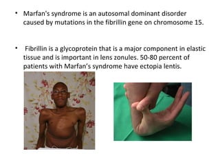 • Marfan's syndrome is an autosomal dominant disorder
caused by mutations in the fibrillin gene on chromosome 15.
•

Fibrillin is a glycoprotein that is a major component in elastic
tissue and is important in lens zonules. 50-80 percent of
patients with Marfan’s syndrome have ectopia lentis.

 