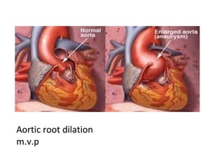 Aortic root dilation
m.v.p

 