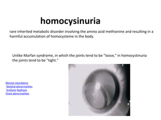 homocysinuria
rare inherited metabolic disorder involving the amino acid methionine and resulting in a
harmful accumulation of homocysteine in the body.

Unlike Marfan syndrome, in which the joints tend to be "loose," in homocystinuria
the joints tend to be "tight."

Mental retardation
Skeletal abnormalities
Scoliosis Kyphosis
Chest abnormalities

 