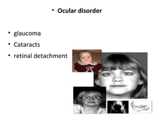 • Ocular disorder
• glaucoma
• Cataracts
• retinal detachment

 