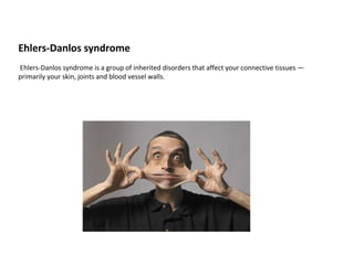 Ehlers-Danlos syndrome
Ehlers-Danlos syndrome is a group of inherited disorders that affect your connective tissues —
primarily your skin, joints and blood vessel walls.

 