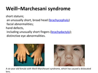 Weill–Marchesani syndrome
short stature;
an unusually short, broad head (brachycephaly)
facial abnormalities;
hand defects,
including unusually short fingers (brachydactyly);
distinctive eye abnormalities.

A six year old female with Weill-Marchesani syndrome, which has caused a dislocated
lens.

 