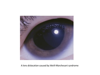 A lens dislocation caused by Weill-Marchesani syndrome

 