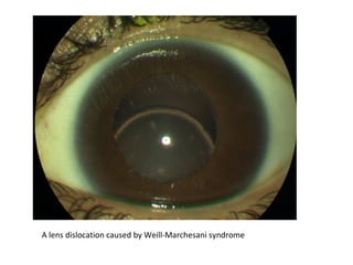 A lens dislocation caused by Weill-Marchesani syndrome

 