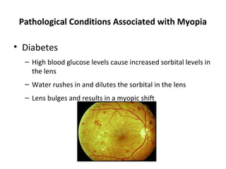 Pathological Conditions Associated with Myopia

• Diabetes
– High blood glucose levels cause increased sorbital levels in
the lens
– Water rushes in and dilutes the sorbital in the lens
– Lens bulges and results in a myopic shift

 