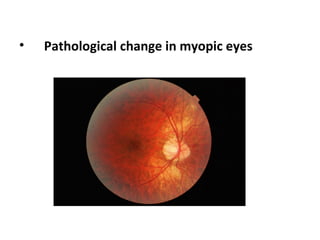 •

Pathological change in myopic eyes

 