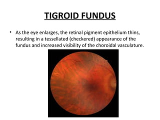 TIGROID FUNDUS
• As the eye enlarges, the retinal pigment epithelium thins,
resulting in a tessellated (checkered) appearance of the
fundus and increased visibility of the choroidal vasculature.

 