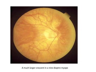 A much larger crescent in a nine dioptre myope

 