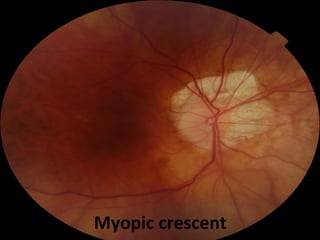 Myopic crescent

 