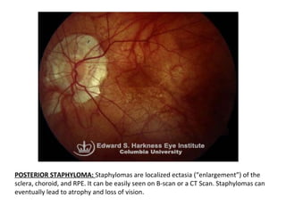 POSTERIOR STAPHYLOMA: Staphylomas are localized ectasia (“enlargement”) of the
sclera, choroid, and RPE. It can be easily seen on B-scan or a CT Scan. Staphylomas can
eventually lead to atrophy and loss of vision.

 