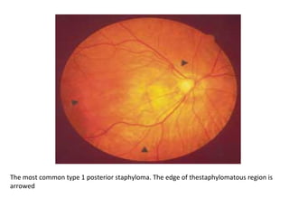 The most common type 1 posterior staphyloma. The edge of thestaphylomatous region is
arrowed

 