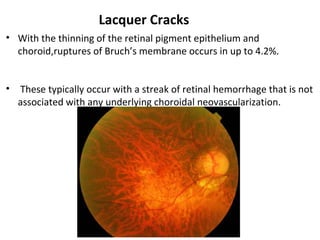 Lacquer Cracks
• With the thinning of the retinal pigment epithelium and
choroid,ruptures of Bruch’s membrane occurs in up to 4.2%.
•

These typically occur with a streak of retinal hemorrhage that is not
associated with any underlying choroidal neovascularization.

 