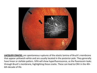 LACQUER CRACKS: are spontaneous ruptures of the elastic lamina of Bruch’s membrane
that appear yellowish-white and are usually located in the posterior pole. They generally
have linear or stellate patters. IVFA will show hyperfluorescence, as the fluorescein leaks
through Bruch’s membrane, highlighting these cracks. These can lead to CNV in the 4th6th decade of life.

 