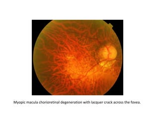 Myopic macula chorioretinal degeneration with lacquer crack across the fovea.

 