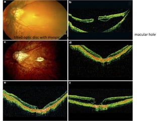 tilted optic disc with myopic crescent

macular hole

 