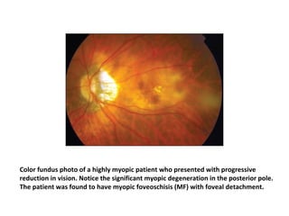 Color fundus photo of a highly myopic patient who presented with progressive
reduction in vision. Notice the significant myopic degeneration in the posterior pole.
The patient was found to have myopic foveoschisis (MF) with foveal detachment.

 