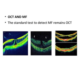• OCT AND MF
• The standard test to detect MF remains OCT

 