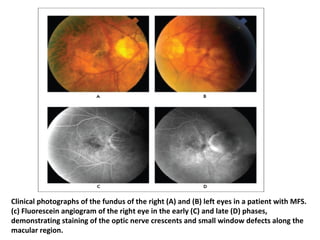 Clinical photographs of the fundus of the right (A) and (B) left eyes in a patient with MFS.
(c) Fluorescein angiogram of the right eye in the early (C) and late (D) phases,
demonstrating staining of the optic nerve crescents and small window defects along the
macular region.

 