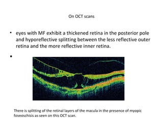 On OCT scans

• eyes with MF exhibit a thickened retina in the posterior pole
and hyporeflective splitting between the less reflective outer
retina and the more reflective inner retina.

•

There is splitting of the retinal layers of the macula in the presence of myopic
foveoschisis as seen on this OCT scan.

 