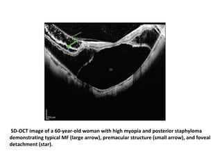 SD-OCT image of a 60-year-old woman with high myopia and posterior staphyloma
demonstrating typical MF (large arrow), premacular structure (small arrow), and foveal
detachment (star).

 