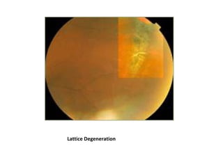 Lattice Degeneration

 
