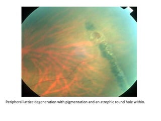 Peripheral lattice degeneration with pigmentation and an atrophic round hole within.

 