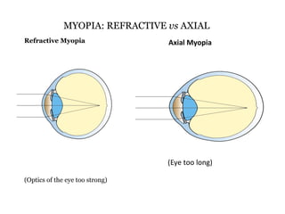MYOPIA: REFRACTIVE vs AXIAL
Refractive Myopia

Axial Myopia

(Eye too long)
(Optics of the eye too strong)

 