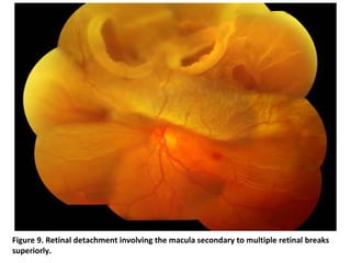 Figure 9. Retinal detachment involving the macula secondary to multiple retinal breaks
superiorly.

 