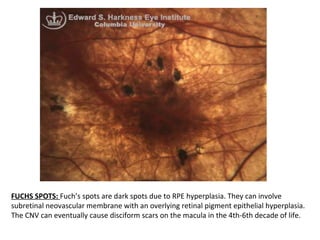 FUCHS SPOTS: Fuch’s spots are dark spots due to RPE hyperplasia. They can involve
subretinal neovascular membrane with an overlying retinal pigment epithelial hyperplasia.
The CNV can eventually cause disciform scars on the macula in the 4th-6th decade of life.

 