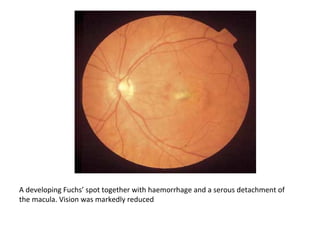 A developing Fuchs’ spot together with haemorrhage and a serous detachment of
the macula. Vision was markedly reduced

 