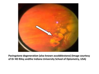 Pavingstone degeneration (also known ascobblestone) (Image courtesy
of Dr HD Riley andthe Indiana University School of Optometry, USA)

 