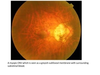 A myopic CNV which is seen as a greyish subfoveal membrane with surrounding
subretinal blood.

 