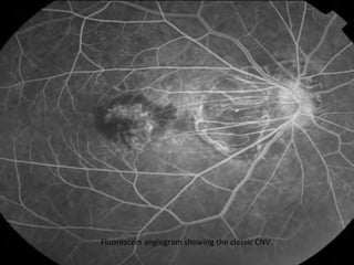 Fluorescein angiogram showing the classic CNV.

 