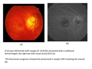 (a)

(b)

A 53-year-old female with myopia of –8.50 DS, presented with a subfoveal
hemorrhagein the right eye with visual acuity 6/15 (a).
The fluorescein anigoram showed the presenceof a myopic CNV involving the macula
(b).

 