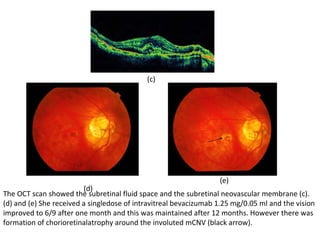 (c)

(e)

(d)
The OCT scan showed the subretinal fluid space and the subretinal neovascular membrane (c).
(d) and (e) She received a singledose of intravitreal bevacizumab 1.25 mg/0.05 ml and the vision
improved to 6/9 after one month and this was maintained after 12 months. However there was
formation of chorioretinalatrophy around the involuted mCNV (black arrow).

 