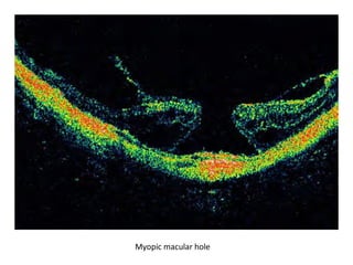 Myopic macular hole

 