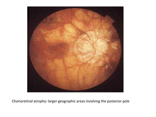 Chorioretinal atrophy: larger geographic areas involving the posterior pole

 
